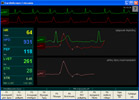 Παράθυρο κυματομορφών του CardioScreen/niccomo